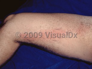 Clinical image of Cellulitis - imageId=51043. Click to open in gallery.  caption: 'Linear erythematous plaques on the thigh (lymphangitis) indicating proximal spread of a more distal cellulitis.'
