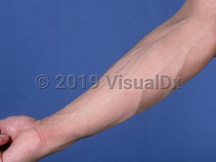 Clinical image of Drug-induced lipodystrophy - imageId=512261. Click to open in gallery.  caption: 'Loss of subcutaneous fat affecting the arm of a patient with AIDS on a combination of medications.'