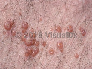 Clinical image of Molluscum contagiosum - imageId=514304. Click to open in gallery.  caption: 'A close-up of a cluster of umbilicated pink papules.'