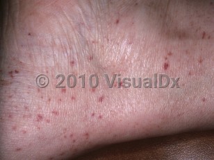 Clinical image of Hyperglobulinemic purpura of Waldenström - imageId=5144640. Click to open in gallery.  caption: 'Purpuric macules and papules around the ankle.'