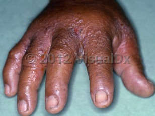 Clinical image of Scombroid fish poisoning - imageId=5181283. Click to open in gallery.  caption: 'Edema, erythema, vesiculation, and crusting on the hand and fingers.'