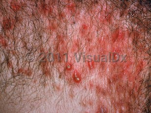 Clinical image of Acne conglobata - imageId=518875. Click to open in gallery.  caption: 'A close-up of numerous, brightly erythematous papules and pustules on the chest.'