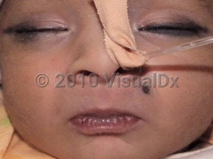 Clinical image of Tetanus neonatorum - imageId=5195577. Click to open in gallery.  caption: 'A 9-day-old who presented with seizures, cyanosis, not feeding at all for 2 days, and unable to cry. On examination there was classical trismus, opisthotonus, clenching of fists, and flexion of arms.'