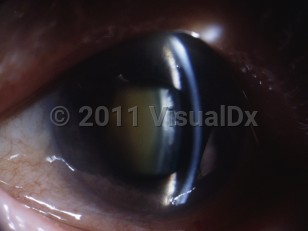 Clinical image of Acute angle-closure glaucoma - imageId=5318399. Click to open in gallery. 