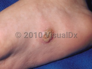 Clinical image of Plantar wart - imageId=53243. Click to open in gallery.  caption: 'A hyperkeratotic plaque on the sole.'