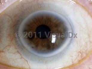 Clinical image of Arcus senilis - imageId=5329507. Click to open in gallery.  caption: 'Thick, white peripheral corneal ring.'