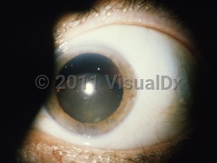 Clinical image of Lens subluxation or dislocation - imageId=5361187. Click to open in gallery.  caption: 'Subluxation of the lens.'
