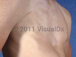 Clinical image of Poland syndrome - imageId=5361728. Click to open in gallery.  caption: 'Absence of the pectoral muscles and nipple-areola complex on the right chest.'