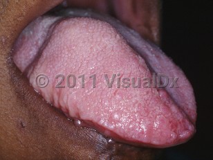 Clinical image of Hemihyperplasia - imageId=5362688. Click to open in gallery. 