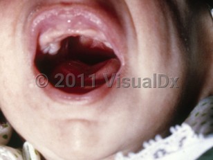 Clinical image of Pierre-Robin syndrome - imageId=5364008. Click to open in gallery.  caption: 'Mandibular hypoplasia.'