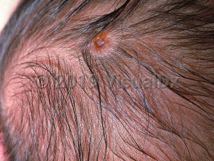 Clinical image of Aplasia cutis congenita - imageId=542277. Click to open in gallery.  caption: 'An atrophic scar with a central crusted ulcer on the scalp.'