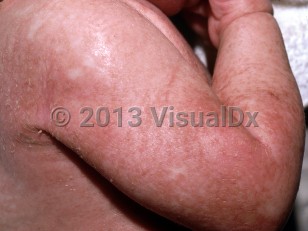 Clinical image of Multiple carboxylase deficiency - imageId=5460992. Click to open in gallery. 