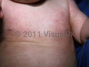 Clinical image of Roseola - imageId=5509644. Click to open in gallery.  caption: 'Discrete and confluent reddish macules, papules, patches, and thin plaques on the arm and trunk.'