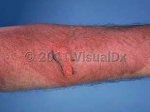 Clinical image of Thermal or electrical burn - imageId=556861. Click to open in gallery.  caption: 'An extensive reddish-brown, wrinkled, eroded plaque on the arm.'