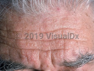 Clinical image of Trichodiscoma - imageId=568319. Click to open in gallery.  caption: 'Many subtle whitish papules on the forehead.'