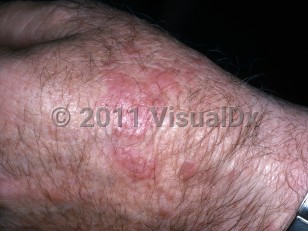 Clinical image of Actinic granuloma - imageId=5687617. Click to open in gallery. 