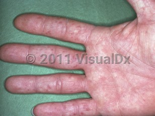 Clinical image of Cold agglutinin disease - imageId=5702275. Click to open in gallery.  caption: 'Reddish and purpuric macules on the fingers secondary to cold agglutinin disease.'