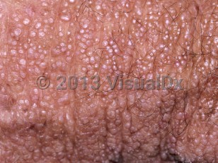 Clinical image of Colloid milium - imageId=5766196. Click to open in gallery.  caption: 'A close-up of myriad tiny pink and whitish papules.'