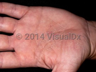 Clinical image of Hand dermatitis - imageId=5794559. Click to open in gallery.  caption: 'An ill-defined scaly and fissured plaque on the palm.'