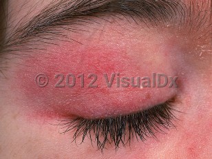Clinical image of Dermatomyositis - imageId=583874. Click to open in gallery.  caption: 'Eyelid erythema of heliotrope rash.'
