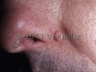 Clinical image of Trichoepithelioma - imageId=5928829. Click to open in gallery.  caption: 'A large, smooth, shiny papule at the nasal alar crease.'