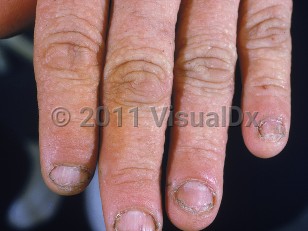Clinical image of Epidermodysplasia verruciformis - imageId=599703. Click to open in gallery.  caption: 'Multiple skin-colored verrucous papules on the fingers.'