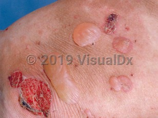 Clinical image of Epidermolysis bullosa acquisita - imageId=603509. Click to open in gallery.  caption: 'A close-up of tense and flaccid vesicles and bullae, and some crusts, on a background of pink erythema and light brown post-inflammatory patches.'