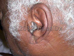 Clinical image of Malignant otitis externa - imageId=6109639. Click to open in gallery.  caption: 'Dull yellow-greenish discharge at the external auditory meatus, secondary to pseudomonal infection.'