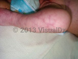 Clinical image of Adams-Oliver syndrome - imageId=6113667. Click to open in gallery.  caption: 'Cutis marmorata telangiectatica congenita, appearing as mottled and retiform reddish and violaceous patches and plaques on the leg.'