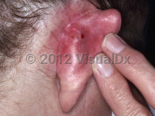 Clinical image of Cutaneous granuloma fissuratum - imageId=6115740. Click to open in gallery.  caption: 'A crusted plaque with surrounding erythema on the posterior ear.'