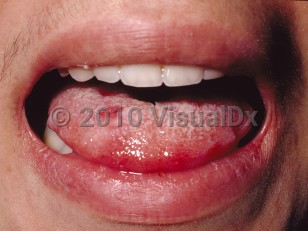 Clinical image of Behçet syndrome - imageId=61375. Click to open in gallery.  caption: 'An erosion and a small ulcer on the tongue.'