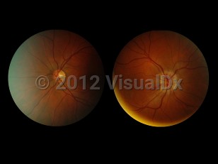 Clinical image of Optic neuritis - imageId=6193472. Click to open in gallery. 