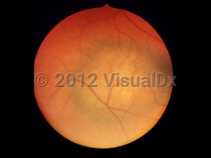 Clinical image of Choroidal melanoma - imageId=6207061. Click to open in gallery. 
