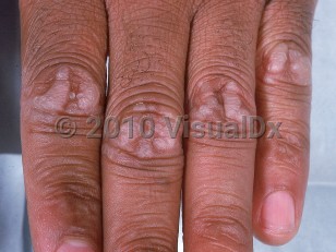 Clinical image of Focal acral hyperkeratosis - imageId=620935. Click to open in gallery.  caption: 'Discrete and confluent pink, scaly papules over the knuckles.'