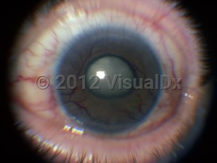 Clinical image of Neovascular glaucoma - imageId=6212977. Click to open in gallery. 