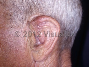 Clinical image of Chronic hematoma of pinna - imageId=6243584. Click to open in gallery. 