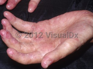 Clinical image of Chronic graft-versus-host disease - imageId=6320846. Click to open in gallery.  caption: 'Sclerodactyly with some pink, scaly, and eroded plaques on the fingertips. Note the thinned thumbnail and scattered hyperkeratotic papules on the palm.'