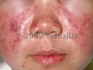 Clinical image of Systemic lupus erythematosus - imageId=63230. Click to open in gallery.  caption: 'Erythema of the cheeks and nose, with superimposed petechiae, purpura, and mottled brown discoloration. Note also the scaling and crusting of the lower lip.'