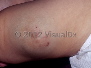 Clinical image of Venous malformation - imageId=6344838. Click to open in gallery.  caption: 'An ill-defined faintly blue tumor with overlying superficial, red vascular papules on the thigh.'