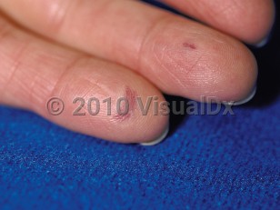 Clinical image of CREST syndrome - imageId=64099. Click to open in gallery.  caption: 'Violaceous, telangiectatic macules on the fingers.'