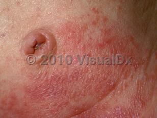 Clinical image of Wiskott-Aldrich syndrome - imageId=64668. Click to open in gallery.  caption: 'Scaly erythematous, eczematous papules and plaques on the lower abdomen.'