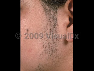 Clinical image of Hirsutism - imageId=647011. Click to open in gallery.  caption: 'Terminal hair growth in the beard area of a female patient secondary to a testosterone-secreting luteoma of pregnancy.'
