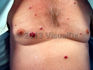 Clinical image of POEMS syndrome - imageId=6555944. Click to open in gallery.  caption: 'Smooth red papules and nodules scattered on the anterior trunk.'
