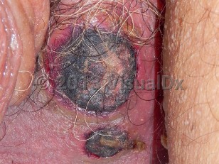 Clinical image of ATRA-induced scrotal ulcer - imageId=6555968. Click to open in gallery.  caption: 'A close-up of eschars with surrounding erythema on the scrotum.'