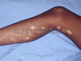 Clinical image of Segmental vitiligo - imageId=6581312. Click to open in gallery.  caption: 'Depigmented and hypopigmented macules and patches on the leg.'