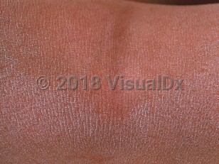 Clinical image of X-linked ichthyosis - imageId=658185. Click to open in gallery.  caption: 'Diffuse fine-scaling around the popliteal fossa.'