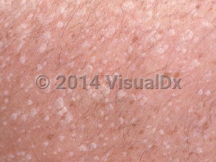 Clinical image of Stucco keratosis - imageId=659194. Click to open in gallery.  caption: 'A close-up of numerous tiny whitish, scaly papules with a stuck-on appearance.'