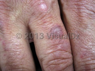Clinical image of Microvenular hemangioma - imageId=6598976. Click to open in gallery.  caption: 'A violaceous and a pink scaly papule on the finger.'