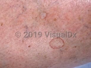 Clinical image of Disseminated superficial actinic porokeratosis - imageId=662415. Click to open in gallery.  caption: 'A close-up of a flat, annular papule and a similar plaque, each with a peripheral hyperkeratotic, ridge-like scale.'