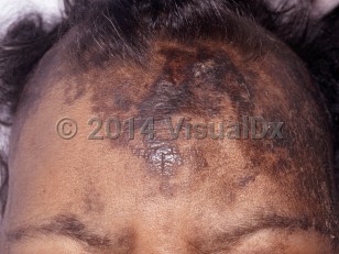 Clinical image of Dermatosis neglecta - imageId=6632756. Click to open in gallery.  caption: 'Numerous dark brown, thick scales of retention hyperkeratosis and some surrounding unrelated postinflamamtory hyperpigmentation on the forehead.'